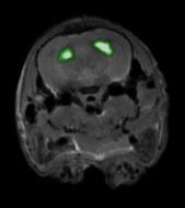 Overlay of SPECT (MRC-SPECT-I) and MR images