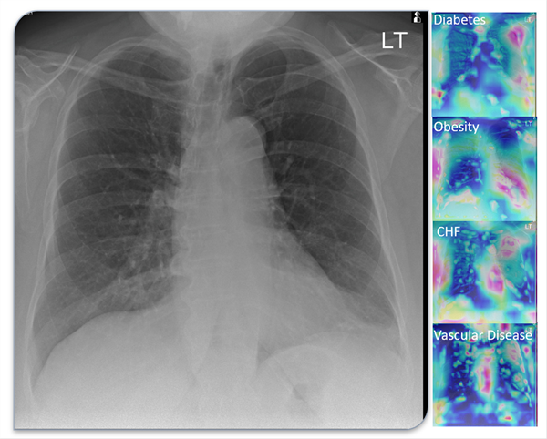 A woman's lung scans after nine days in the hospital with COVID-19.