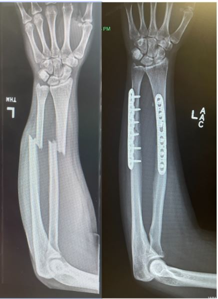 Brainstorming Solutions to (Re)Fractures