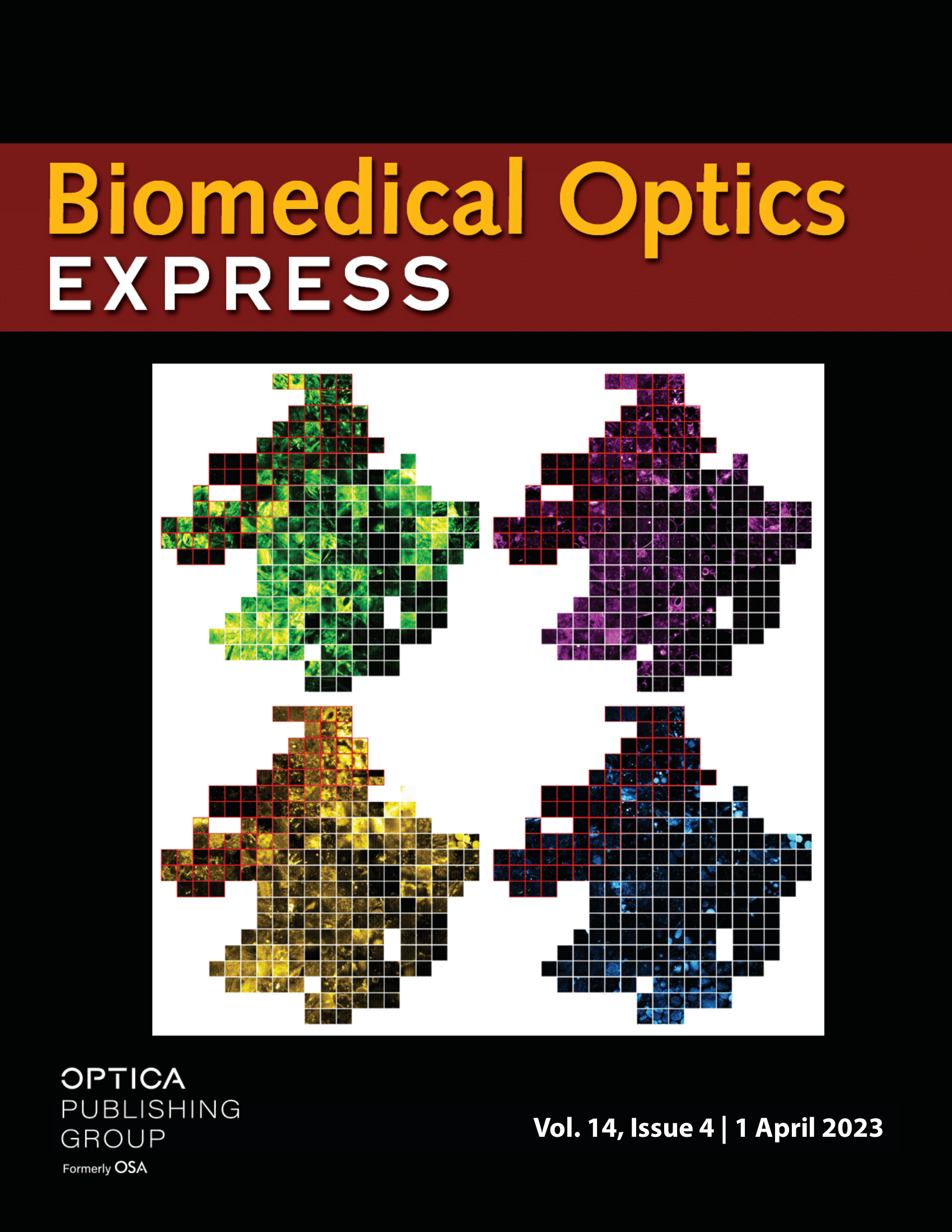 Weakly supervised identification of microscopic human breast cancer-related optical signatures from normal-appearing breast tissue